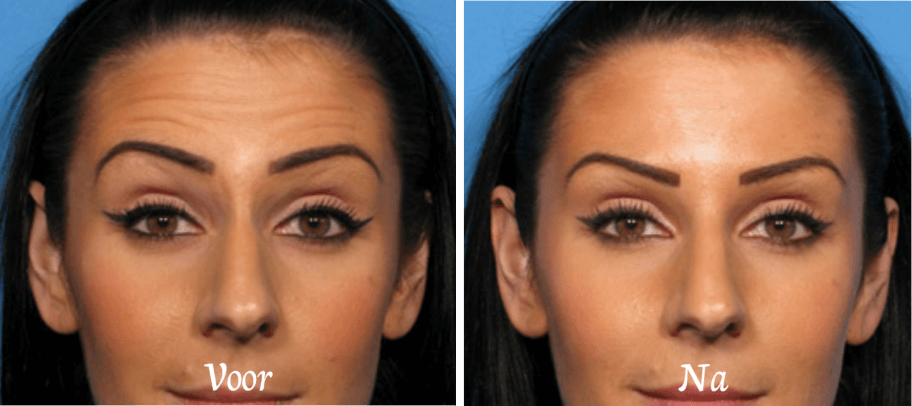 botox-voorhoofd dreamclinics